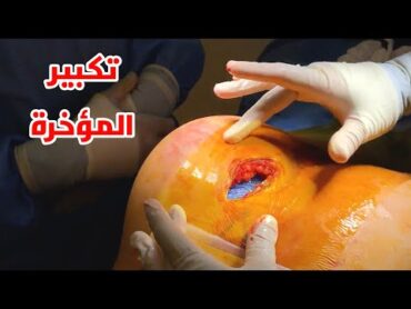 شاهد عملية تكبير المؤخرة Surgical buttock augmentation