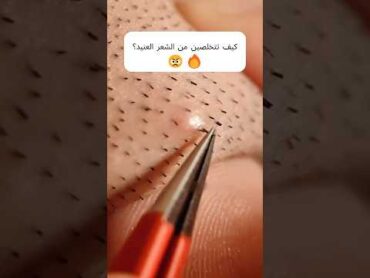 ما هي الطريقة الصحيحة لإزالة الشعر ؟foryou mlay kinseibeauty hair fyp