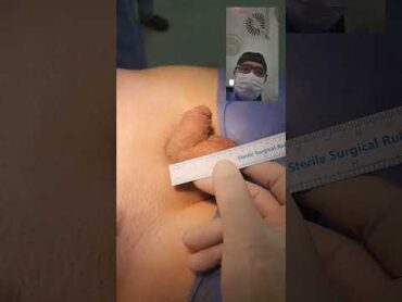 Penile enlargement surgery  Penis surgery  Dr . Araz Bayramov