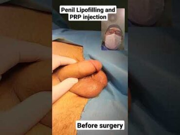 Penil lipofilling and PRP injection by Dr Araz Bayramov penil penis penilenlargement.com