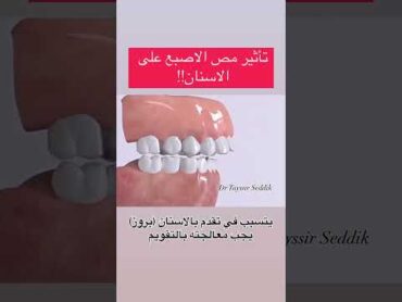 تأثير مص الاصبع على الاسنان👎🏻🦷