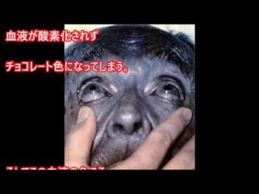 【衝撃】ありえない！？とんでもない近親婚を繰り返した結果・・・一家全員まっ青な肌のファゲイト一族とは？ありえない真実。