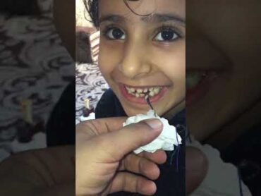 خلع سن عواشة