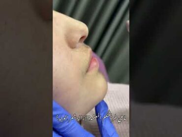 إزالة شعر الوجه بالشمع  إزالة الشعر الزائد بطريقة سهلة