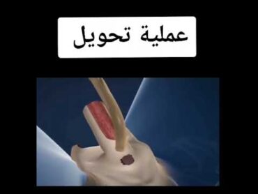 عملية تحويل مهند الرديني من ذكر ألى أنثى😩🤦🏻👉🏻 الفيديو لايناسب أصحاب القلوب الضعيفه 😩