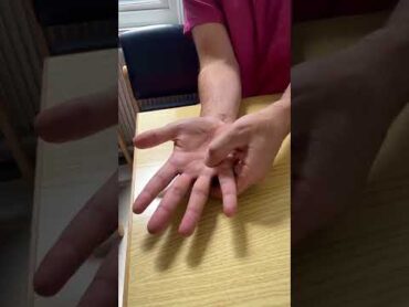 Trigger finger Transverse Friction