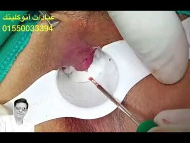إزالة البواسير بالليزر  أ.دوائل متولى
