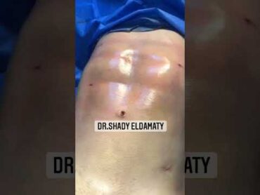 نتيجة شفط دهون البطن ونحت الجسم في Change me clinic شفط الدهون