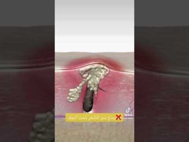 ❌يمنع نمو الشعر تحت الجلدforyoupage❤️❤️ shaving kinseibeautylaser foryou e3 foryou