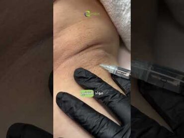 تفتيح منطقة الإبط من الجلسات المهمة لكل أنثى! clinic sharjah إبط underarmcare sharjah