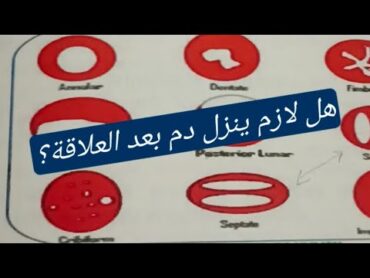 هل لازم ينزل دم بعد العلاقة ؟ و ايه انواع غشاء البكارة؟ و امتى ينزل دم و امتى ماينزلش؟