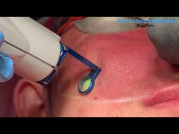 Birthmark Treatment Procedure with Prof.Dr.Ikram Ullah Khan