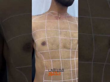 ازالة شعر الصدر و البطن بالليزر للرجال