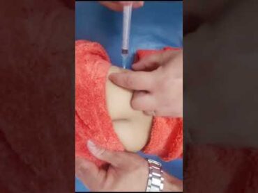ابرتين حقنة عضل intramusclar injection