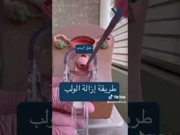 طريقة ازالة اللولب اكسبلور ترندتيكتوك حمل pregnantwoman تيك توك ترند fyp