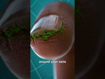 Why You Shouldn&39;t Bite Your Nails 😖