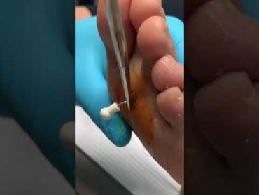 Did you know podiatrists can fix broken bones? shorts