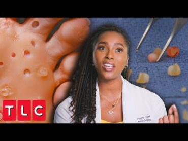 Dr. Ebonie Removes Over 200 Lesions From Patient&39;s Feet!  My Feet Are Killing Me
