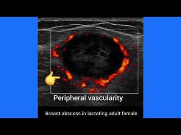Breast Abscess in Lactating Mothers: Ultrasound & color Doppler Diagnosis, management Explained