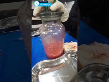 Butt Augmentation Using Fat Grafting and Result  Brazilian Butt Lift shortfeed shorts