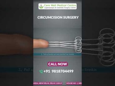 ZSR Circumcision Surgery in Delhi: A StepbyStep Animated Guide  Circumcision Surgery Cost shorts