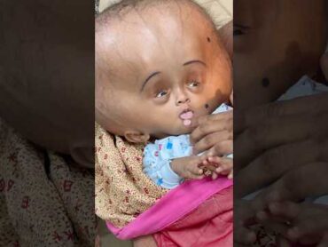 His head is of 18 kgs. He is just 6 months old. The cost of his surgery is raised by our video❤️